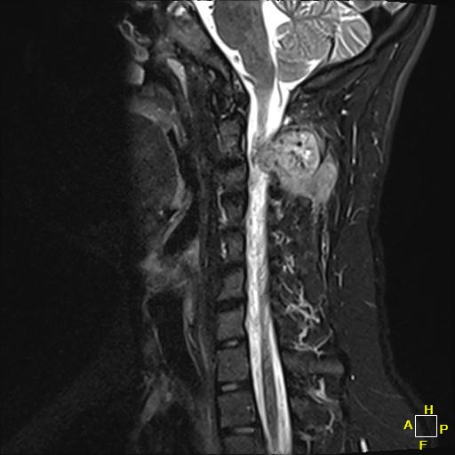 𝘾𝙖𝙨𝙚 𝙤𝙛 𝙩𝙝𝙚 𝙒𝙚𝙚𝙠 from @BlakeBartonMD of @CC_SportsMed A 16-year-old presents with 2 months of progressive neck pain and facial numbness. Symptoms worsened despite 💊. An MRI was ordered. What is on your differential for the findings below? tinyurl.com/452appbm