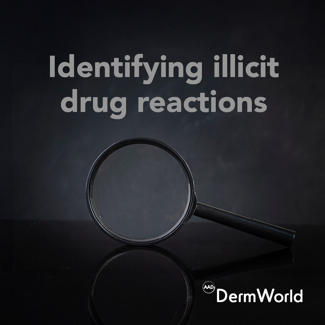 Across the United States, illicit drug use has never been higher. #DermWorld talks to experts about cutaneous signs of drug abuse and how #dermatologists can assist with much-needed multidisciplinary care. ⬇️ aad.org/dw/monthly/202… @VasquezMd49920 @MishaRosenbach