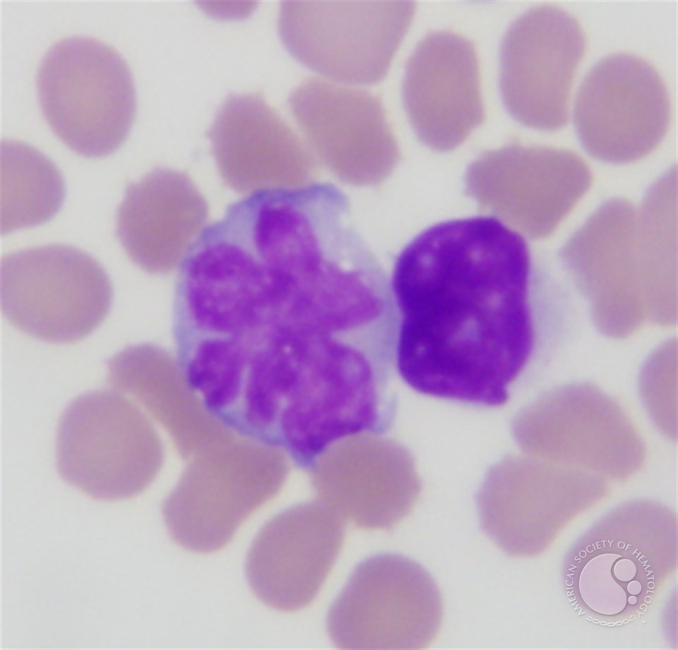 ALK-negative anaplastic large cell lymphoma, leukemic phase | ASH Image Bank | American Society of Hematology imagebank.hematology.org/image/17922/al… #ASHImageBank #lymsm