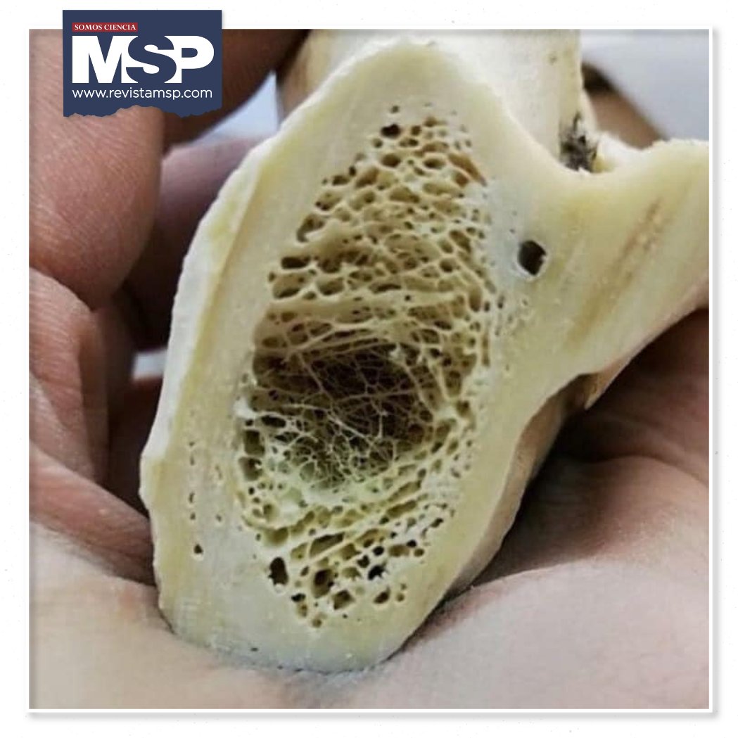 #ImágenDelDíaMSP 🖼️ Así se ve el interior de un hueso con #Osteoporosis, una enfermedad se caracteriza por la disminución de la densidad ósea y el deterioro de la estructura del tejido óseo. 👉 ow.ly/qOwj50RAZNn 

Crédito: Medicina Apasionante 

#MSP #SomosCiencia