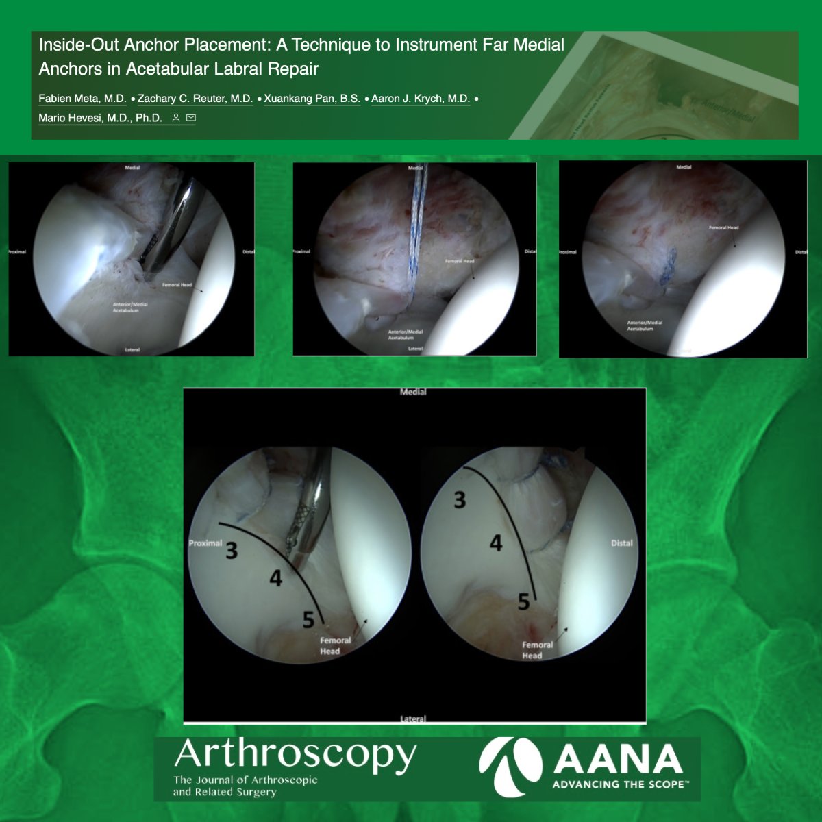 Inside-Out Anchor Placement: A Technique to Instrument Far Medial Anchors in Acetabular Labral Repair #HipArthroscopy #LabralRepair @MarioHevesiMD @DrKrych ow.ly/qRCU50Rt2Lc