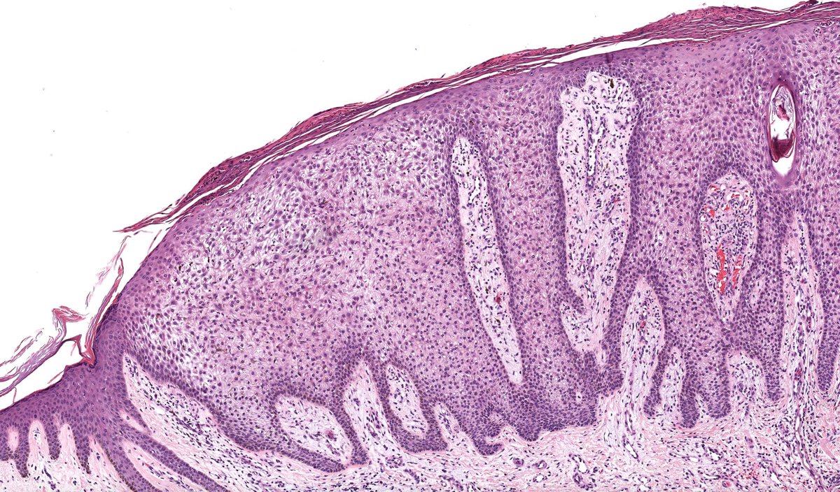 JMGardnerMD's tweet photo. Solitary red papule. Diagnosis? (This one is as classic as it gets!) 
Digital slide &amp; Answer 🔬 ✅ https://t.co/2xqDWkepDA 
Videos ⏯️ https://t.co/jIc4Wrhjcf &amp; https://t.co/f1KUvd9JhV
#pathology #pathologists #pathTwitter #dermpath #dermatology #dermatologia #dermtwitter https://t.co/k5FDDLtbWC