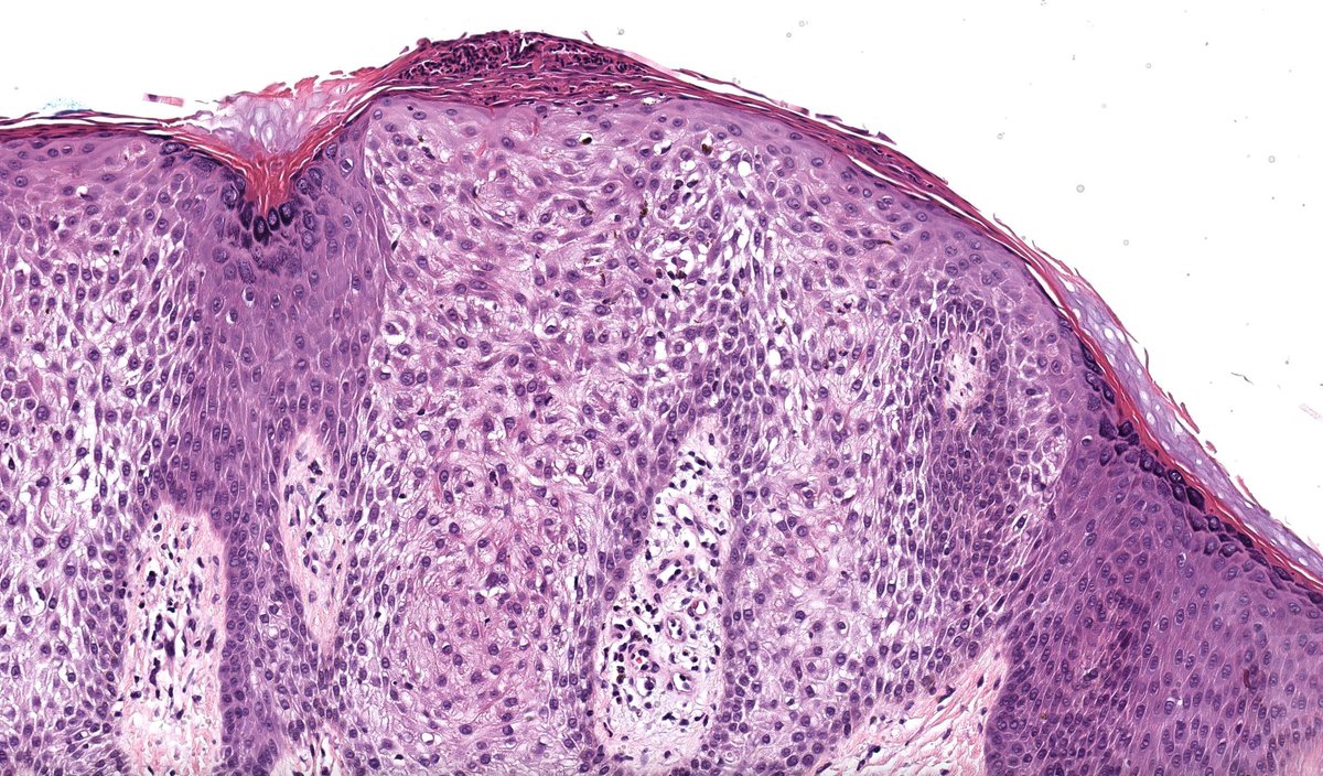 JMGardnerMD's tweet photo. Solitary red papule. Diagnosis? (This one is as classic as it gets!) 
Digital slide &amp; Answer 🔬 ✅ https://t.co/2xqDWkepDA 
Videos ⏯️ https://t.co/jIc4Wrhjcf &amp; https://t.co/f1KUvd9JhV
#pathology #pathologists #pathTwitter #dermpath #dermatology #dermatologia #dermtwitter https://t.co/k5FDDLtbWC