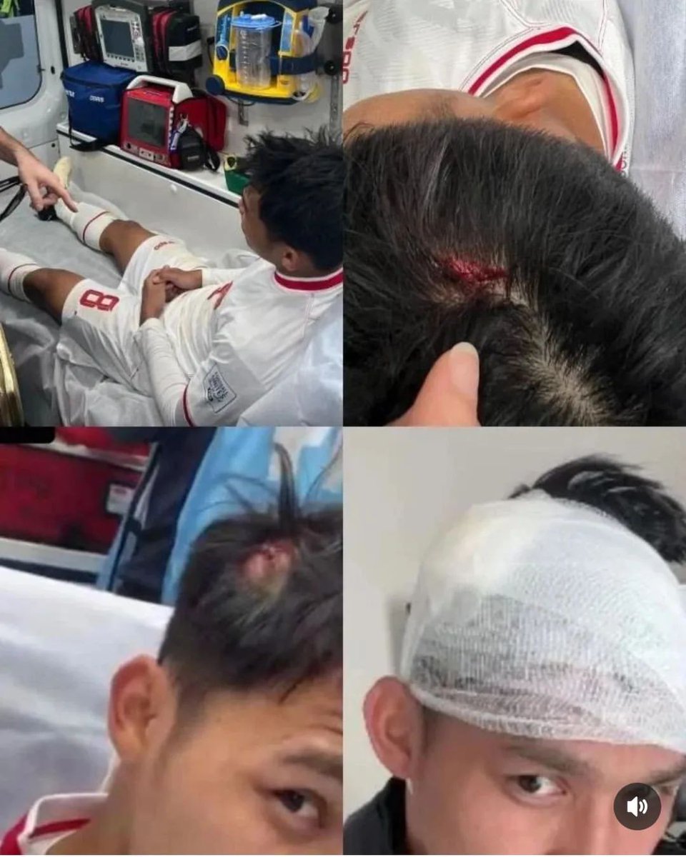 gilabola_ina's tweet photo. Di pertandingan menghadapi Guinea tadi malam, Witan mendapatkan luka yang cukup parah di kepalanya. 

Namun di laga tersebut Witan masih mampu bermain full time dengan menahan rasa sakit.

Setelah pertandingan selesai, Witan mendapatkan 5 jahitan di kepalanya.

GWS dek Witan 🙏 https://t.co/xKRSzZWbxR