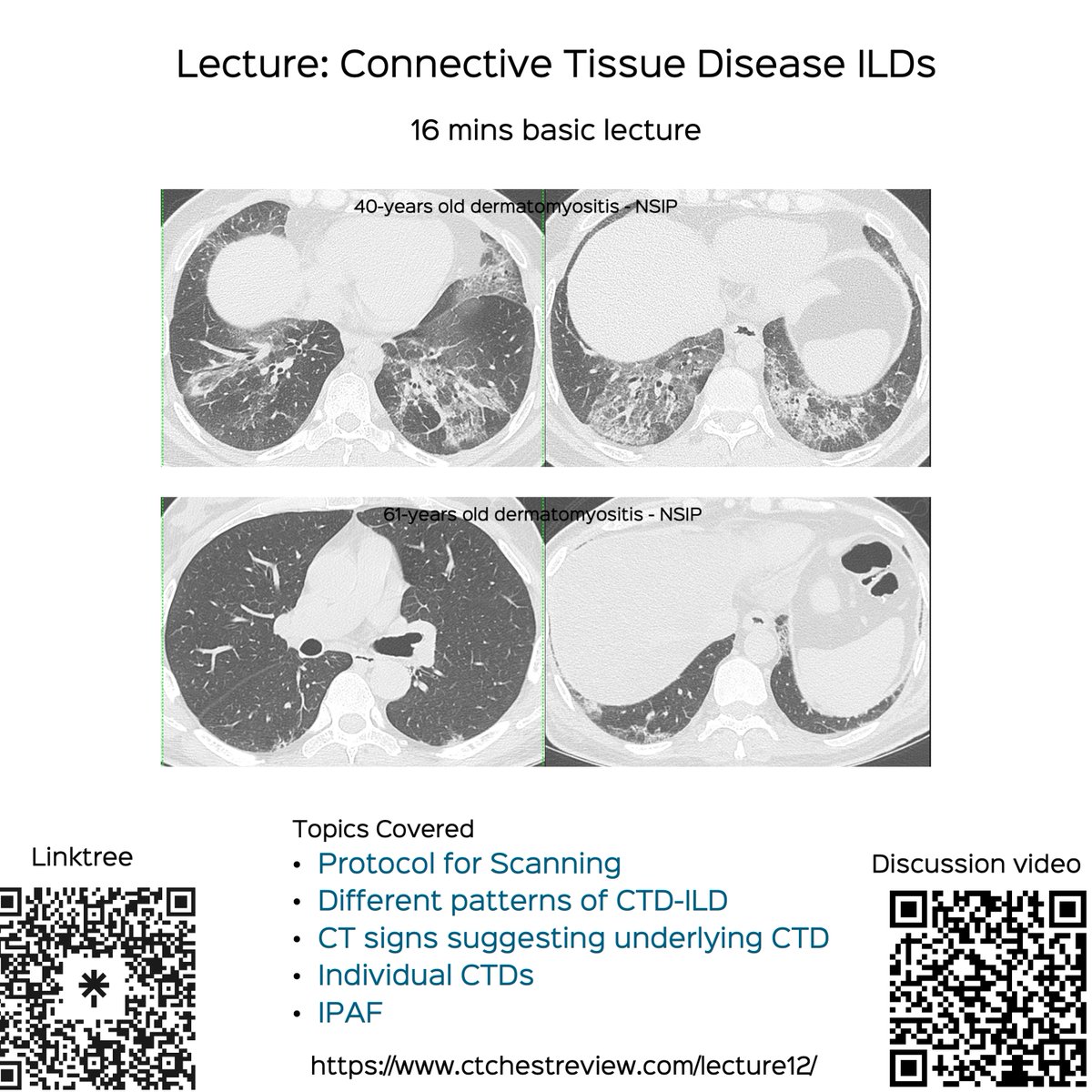 Lecture: Connective Tissue Disease ILDs

16 minutes basic lecture on this subject

ctchestreview.com/lecture12/

#ctchest #radres #foamrad #connectivetissuedisease #CTD #CTDILD