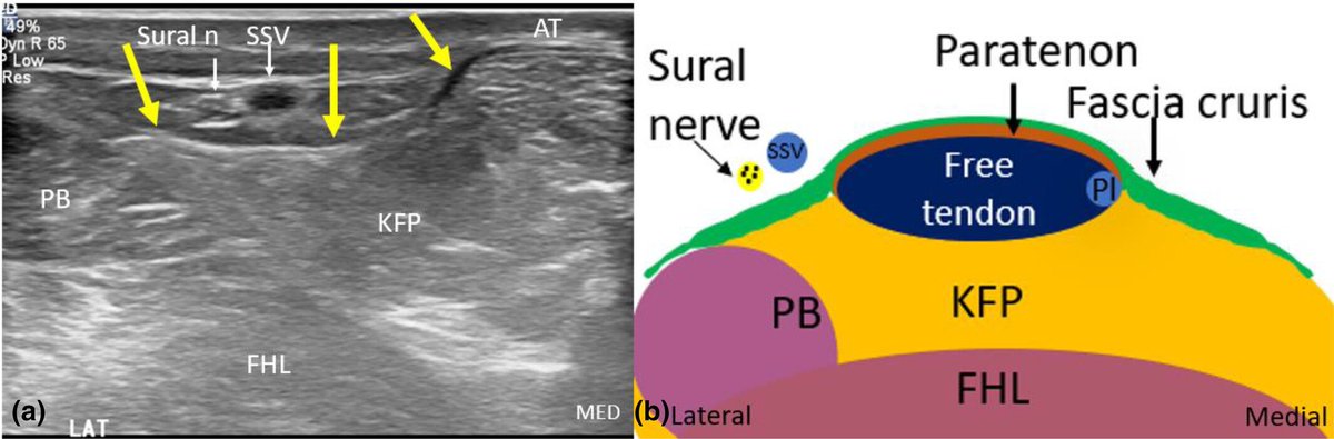 Ultrasound assessment of acute Achilles tendon rupture and measurement of the tendon gap Open acess onlinelibrary.wiley.com/doi/10.1002/aj…