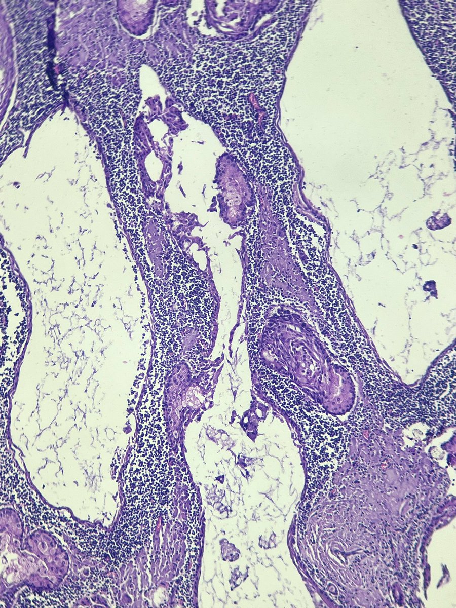 60s/M Neck mass 
Thoughts 🗯️

#PathTwitter #HNpath #ENTpath #PathX