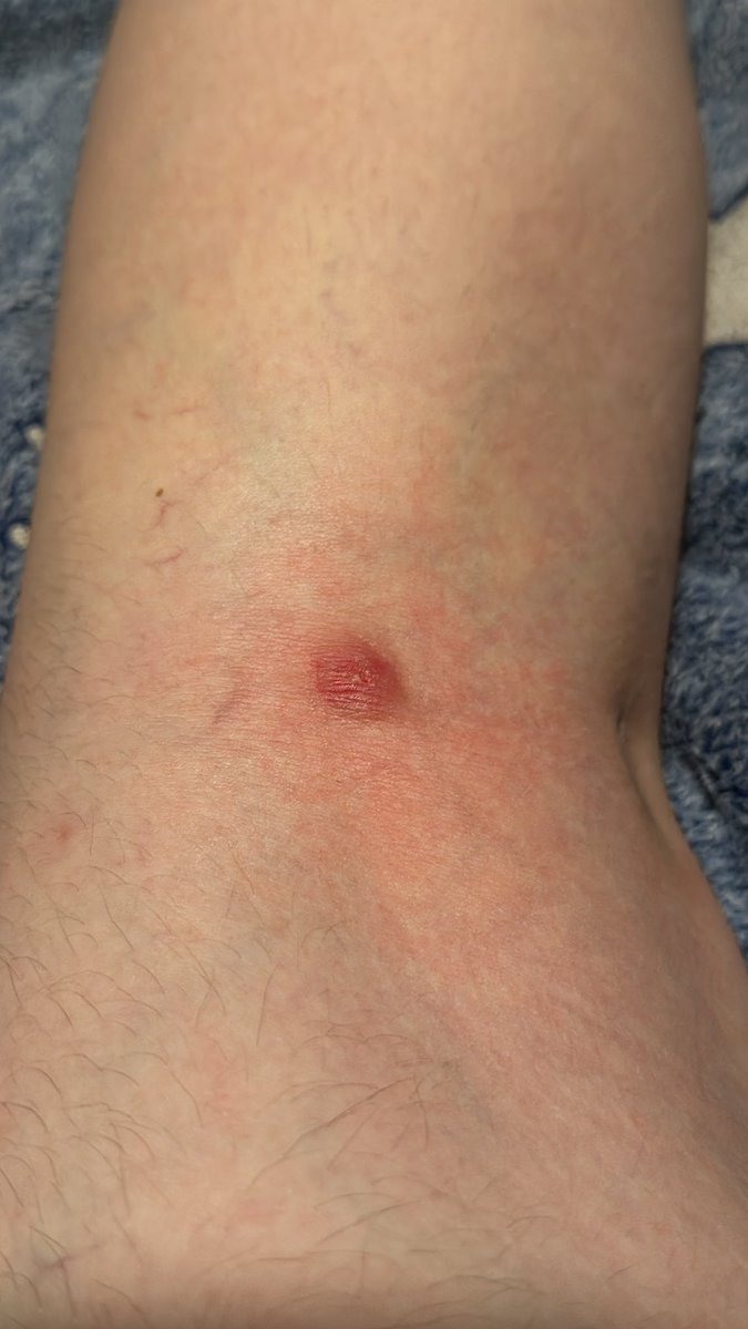 should i be concerned? i think it’s a #spiderbite #help