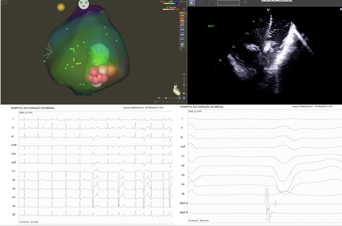 Two niece cases Yesterday First PCV induced cardiomyopathy EF 25%- GCV Second PCV induced Cardiomyopathy EF 35%- Moderador Band w/@simoneeccosbr @luizrleite and the CAS @doug_araujjo @crpisani @AndreAssisCarmo @Codietrich @CarinaHardy4 @LArmaganijan @fvassallomd