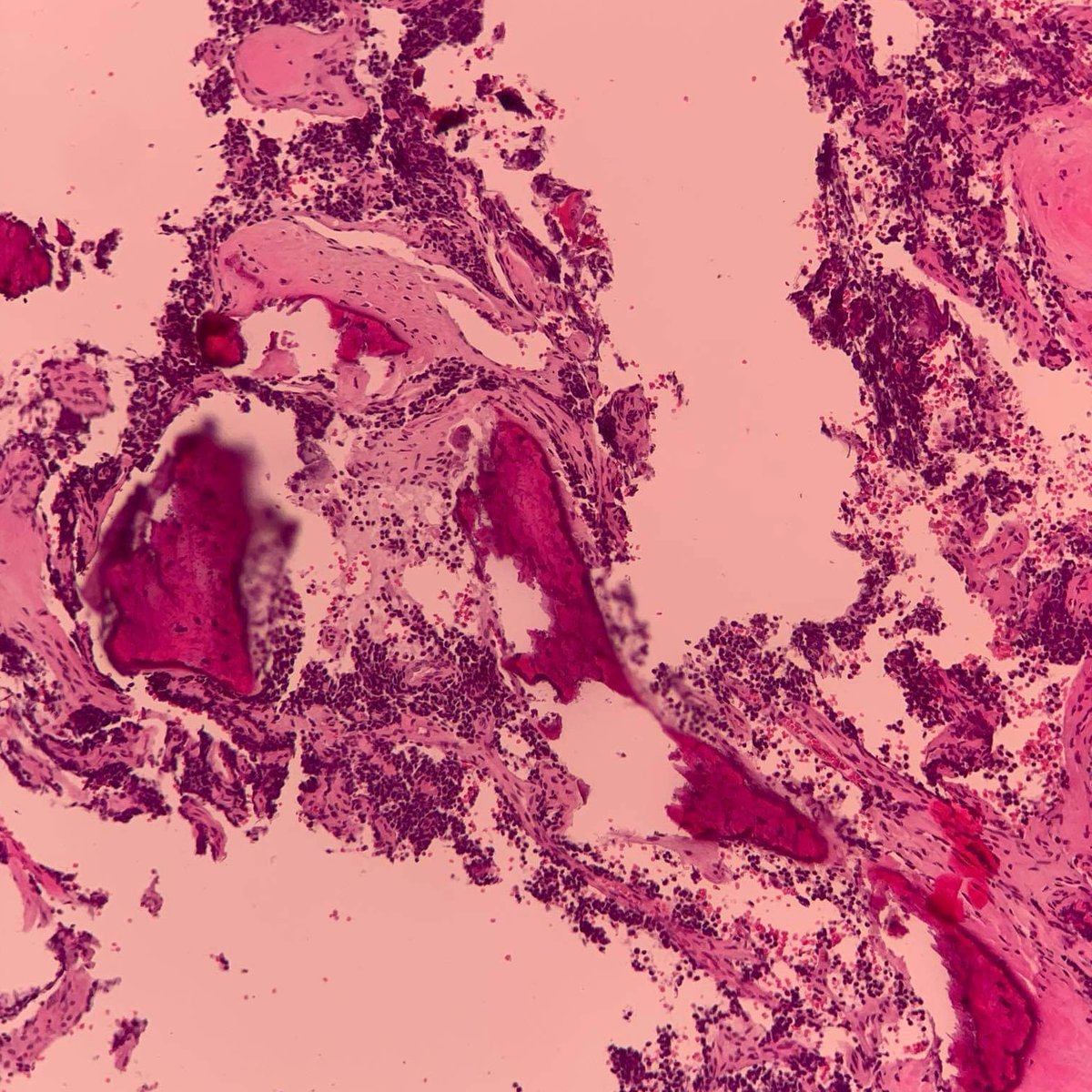 Bone case, 8yo female, bone lytic lesion of left proximal tibia, curettage biopsy was performed. Radiologically: osteosarcoma, chondrosarcoma, Ewings sarcoma. What is your diagnosis? #PathTwitter #pathtweet
IHC: Cd45 /-/ Ck pan /-/ Cd20 /-/ Vimentin /+/ Synaptophysin /-/ Cd99 /+/