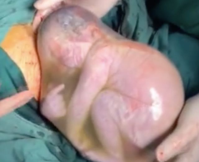 Paramedics Save 26 Week Premature Baby Still in His Amniotic Sac buff.ly/4dJnhk3