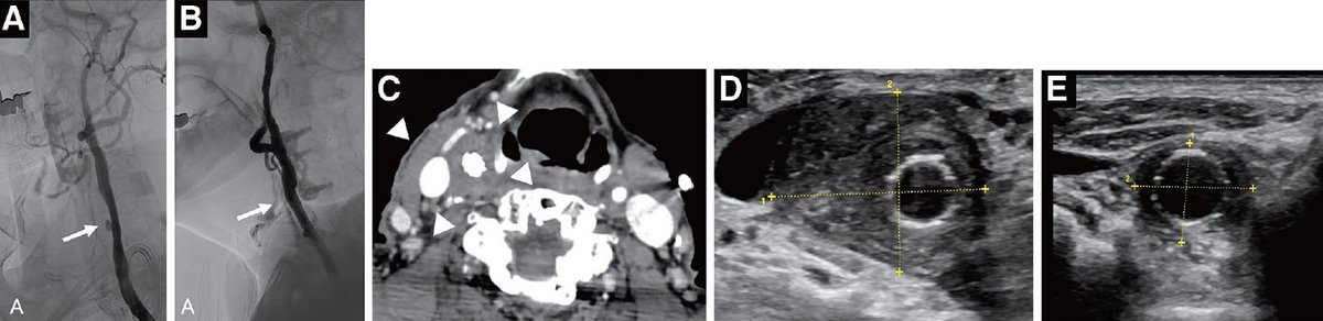 JNETjournal's tweet photo. Case Report
Delayed Stent Infection after Deployment of a Carotid Dual Layer Stent in Dialysis Cases
https://t.co/yuIty6pRVU
#CarotidArteryStenting #DualLayerStent #Dialysis #InfectedAneurysm #StentGraft https://t.co/Vhjz5pPoTD