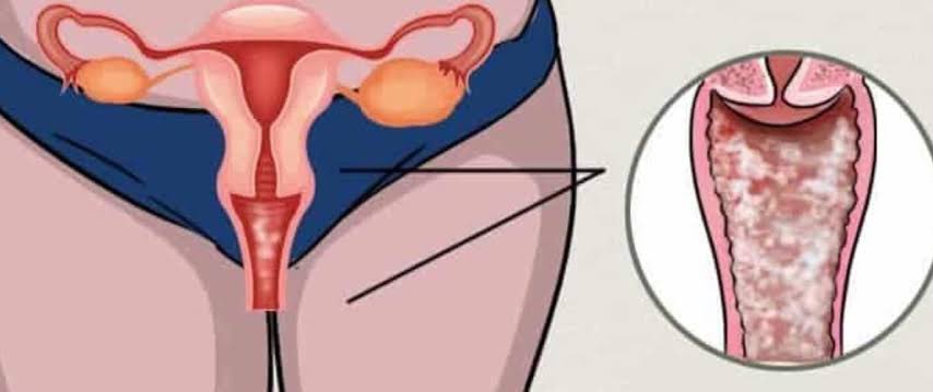 A lot of women are tired of treating recurrent vaginal yeast infections. 

But here are some common ways they keep inviting the infection without knowing 

Come with me 👇