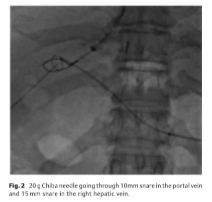 The Arab Journal of Interventional Radiology (@arabjir) on Twitter photo #AJIR Original Article: Trans-splenic Approach for Transjugular Intrahepatic Portosystemic Shunt (TIPS) Creation in Patients with Portal Vein Thrombosis
<a href="/MaryamBoumezrag/">Maryam Boumezrag, MD</a> <a href="/saherssabri/">Saher Sabri</a>
Abstract: thieme-connect.com/products/ejour…
HTML: thieme-connect.com/products/ejour…
PDF: thieme-connect.com/products/ejour… #AJIR Original Article: Trans-splenic Approach for Transjugular Intrahepatic Portosystemic Shunt (TIPS) Creation in Patients with Portal Vein Thrombosis
<a href="/MaryamBoumezrag/">Maryam Boumezrag, MD</a> <a href="/saherssabri/">Saher Sabri</a>
Abstract: thieme-connect.com/products/ejour…
HTML: thieme-connect.com/products/ejour…
PDF: thieme-connect.com/products/ejour…