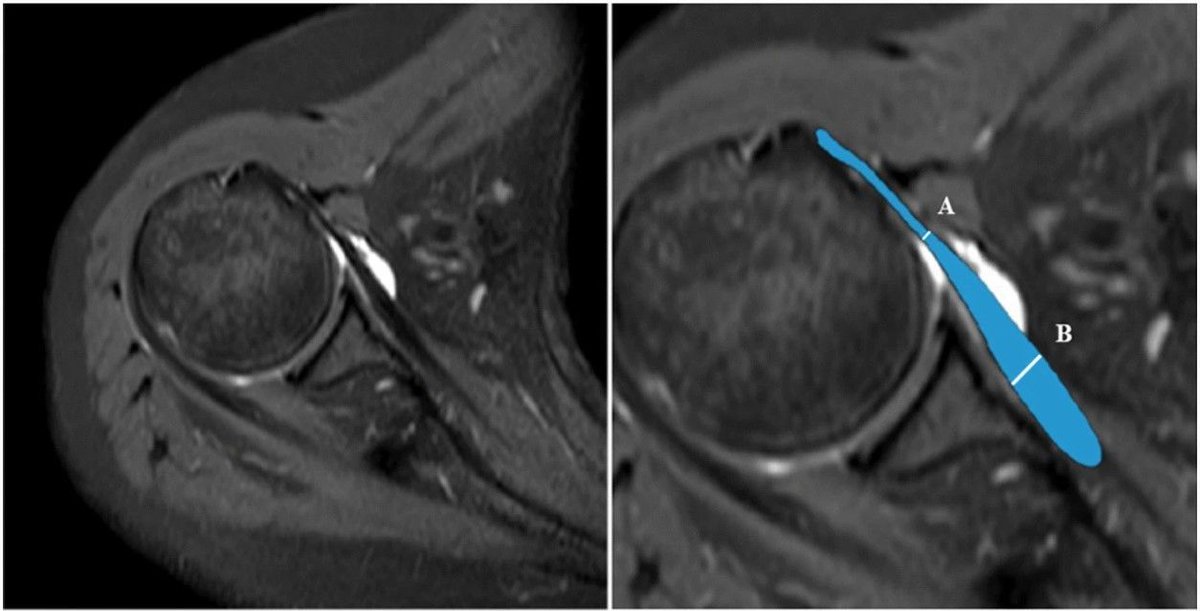 Qiqi Wang et al. investigate the quantitative indicators and features of partial subscapularis tears on conventional shoulder #MRI, which can be used to improve the accuracy of preoperative MRI diagnosis.

#InsightsIntoImaging

🔗 buff.ly/44sB0HA