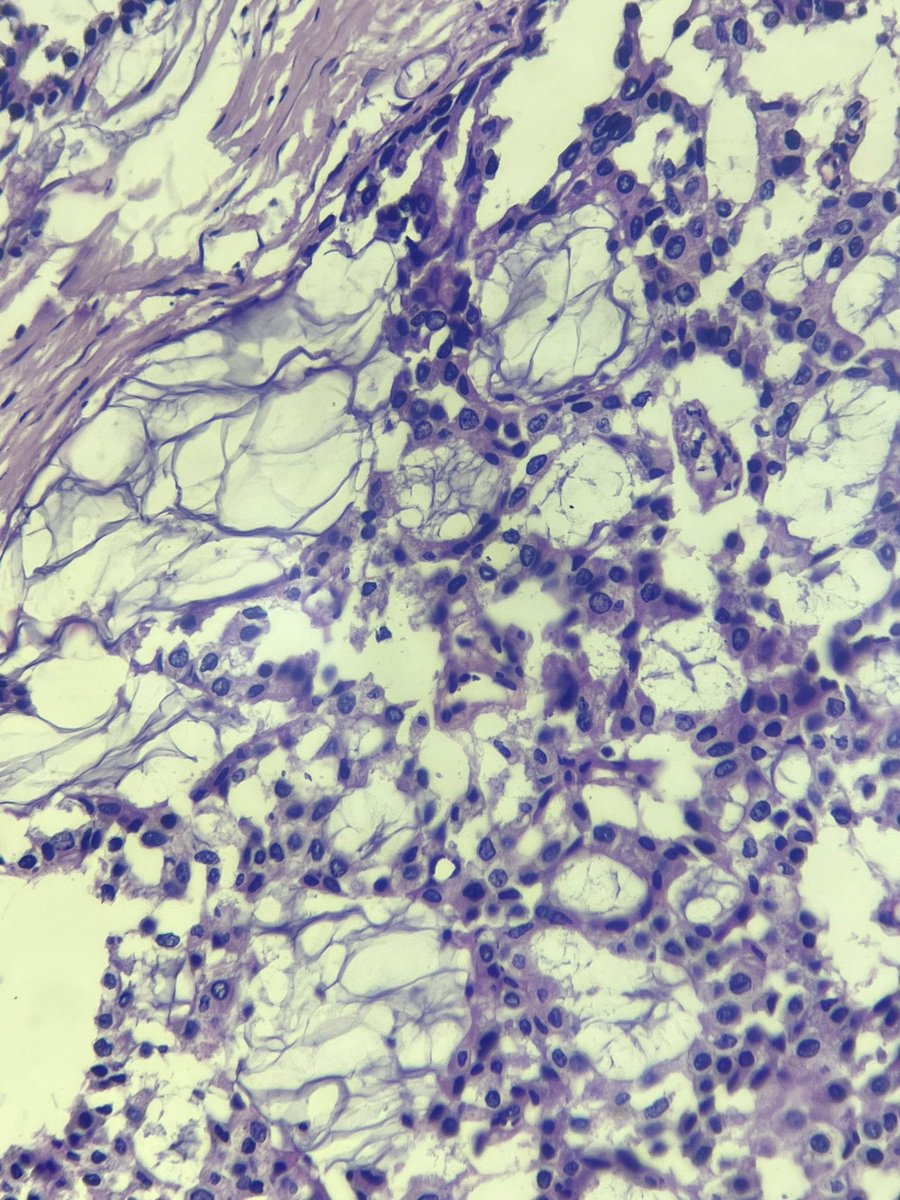 ‘The secret of happiness is to find a congenial monotony’

50s/M 
Nodule in cheek 

Is it too close to diagnose ? 
Thoughts 🗯️

#PathTwitter #HNpath #headandneckpath #dermpath