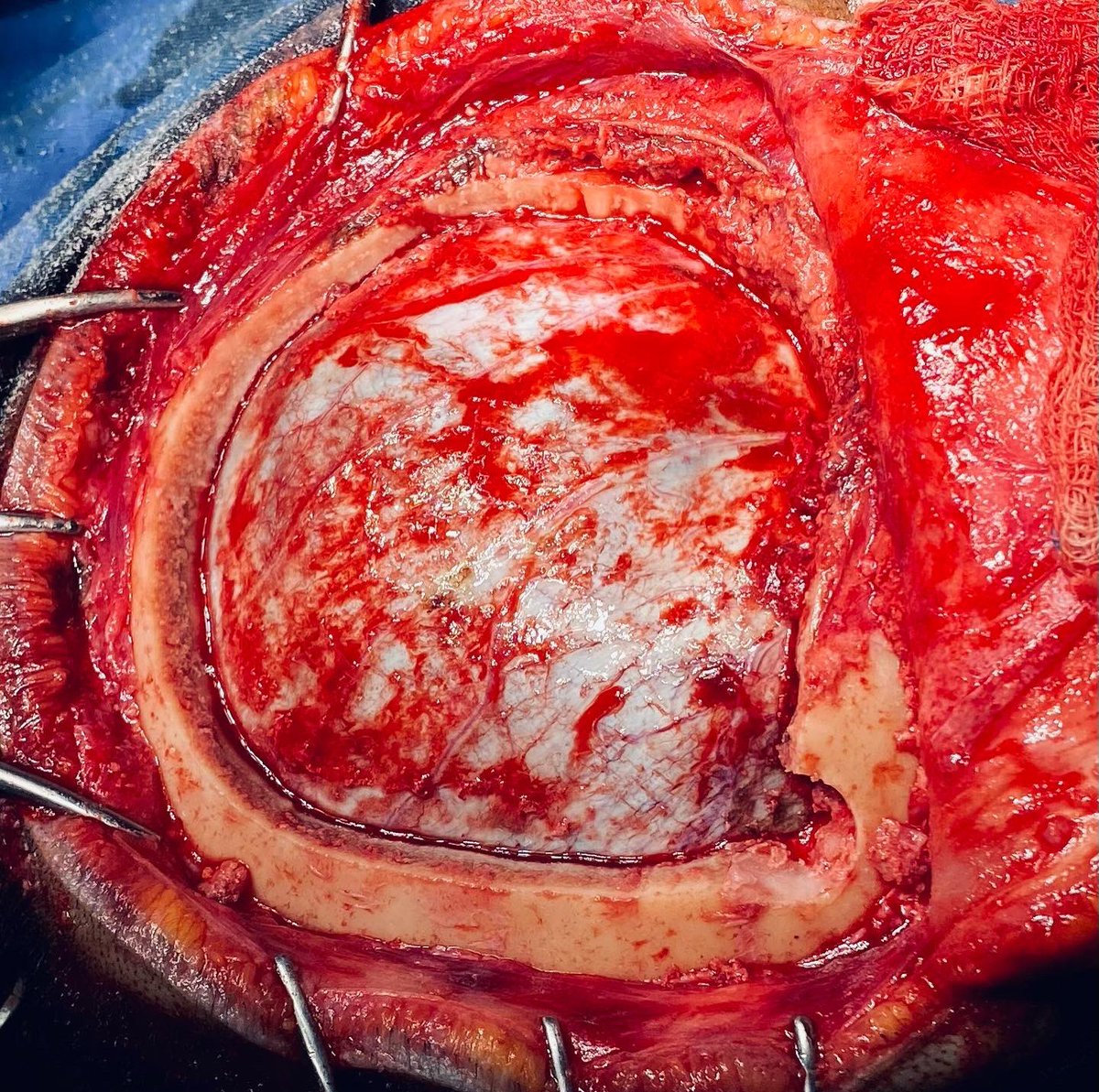 ChavezRamzes's tweet photo. Drainage of a subdural hemorrhage

From dura to closure 

Image 1 : craniotomy
Image 2: durotomy 
Image 3: drainage
Image 4: closure https://t.co/xwnYsD8Wjw