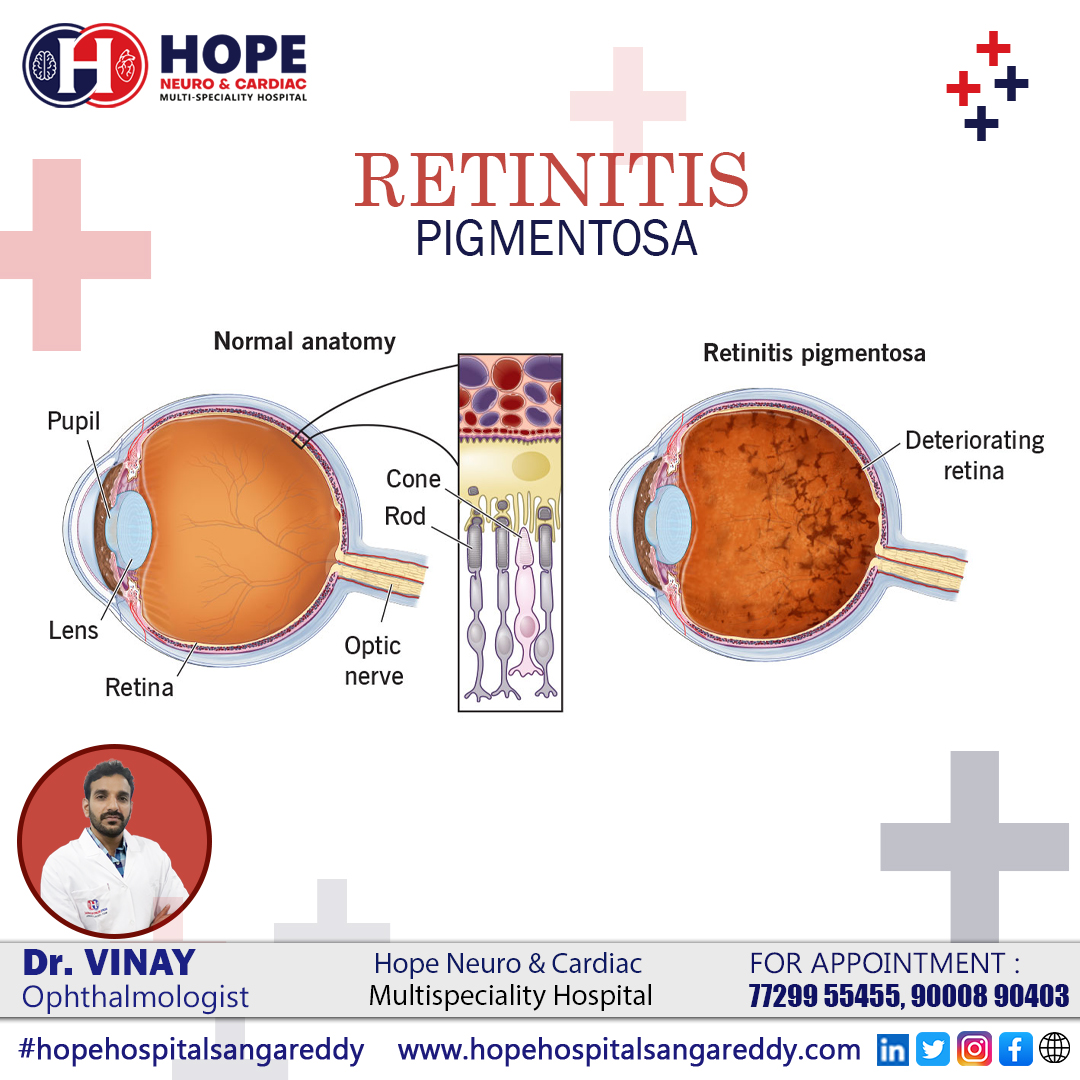 Hope Neuro & Cardiac Multispeciality Hospital Sangareddy

Retinitis Pigmentosa

Dr. Vinay Jitta

Ophthalmologist

For Appointment

8885333053

#retinitispigmentosa #Eyesproblem #pigmentos #EyeDiseasePrevention