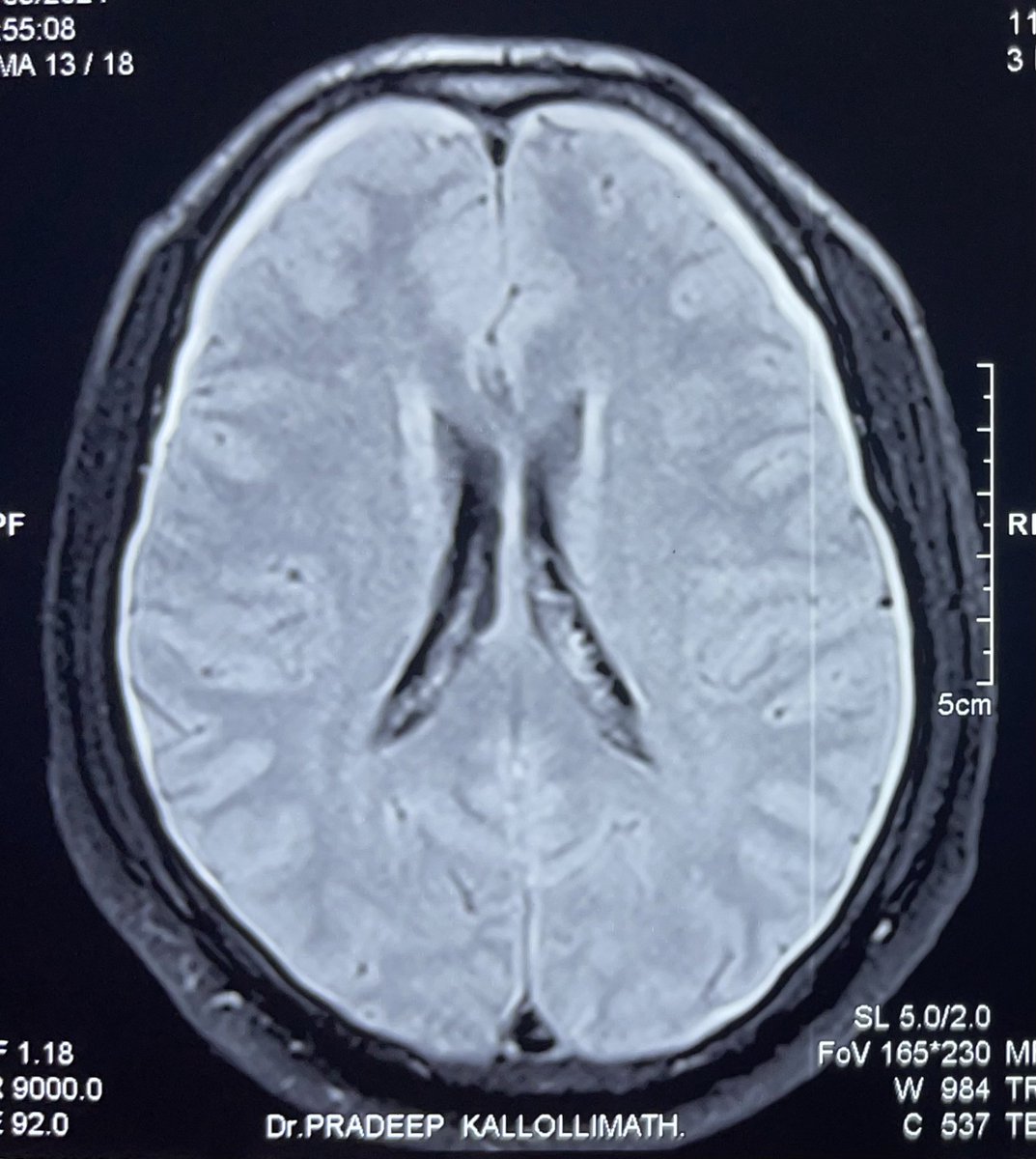 51 years old man with severe orthostatic headache since10 days, which is relieved by lying in recumbent position. 

Diagnosis?
What are the next steps in management? 

#MedTwitter #NeuroTwitter #MedX