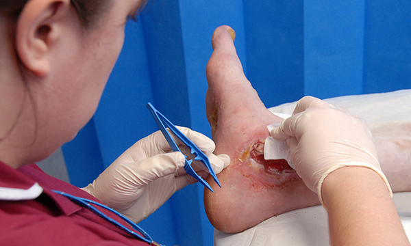 Wound care in older people: a guide for nurses This article explores how conducting holistic wound assessments and using management strategies tailored to each person’s needs can have a positive effect on older people’s quality of life. journals.rcni.com/nursing-older-…