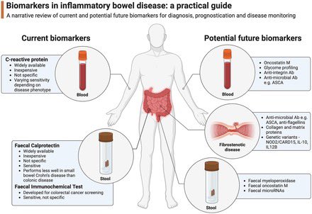 How can we get the most out of existing IBD biomarkers, and what does the future of non-invasive IBD monitoring look like? Thanks to @TAGastroenterol for publishing our narrative review @Sash_Honap @RichardPollok @StGeorgesTrust journals.sagepub.com/doi/10.1177/17…