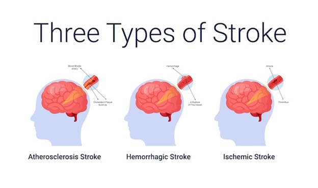 Recognizing National American Stroke Month by spreading awareness about stroke signs and the urgency of timely care. Our expert nursing staff is on hand to educate and assist. ⏱️ #KnowStrokeSigns #EmergencyResponse #WebsterHomeCare