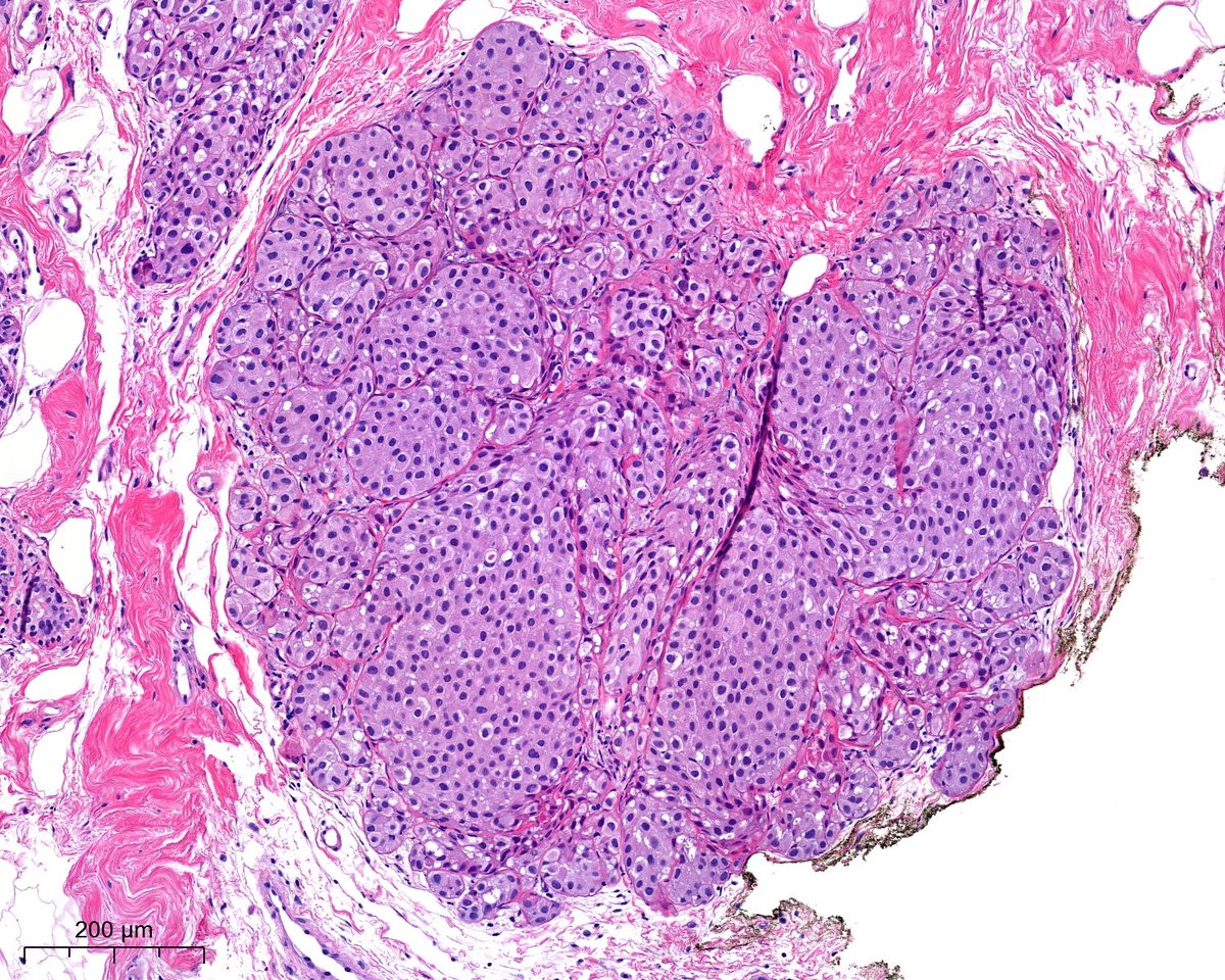 #breastpath Microcalcifications!🤓Any IHC? despite the obvious... @atman_ci @DrGeeONE @fouad_boulos @ariella8 @surgpathlahore @amalasar86 @TristanRutland7 @LoboAnandi @SumantaDas_7 @kis_lorand @padmapathology1 @nucleololailo @joaquinnieves55 @DrBMcGinn @Histopatolomon