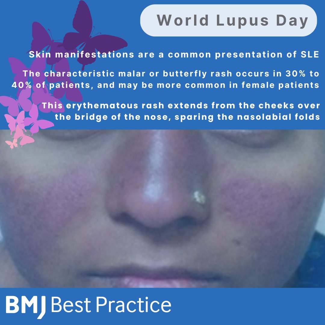 Antinuclear antibody is the most sensitive test for confirming the diagnosis of sytemic lupus ertythematosus when accompanied by typical clinical findings. However, ANA is not specific to #SLE & may be positive in other diseases bit.ly/3M3Pa87 @LUPUSUK @WorldLupusFed