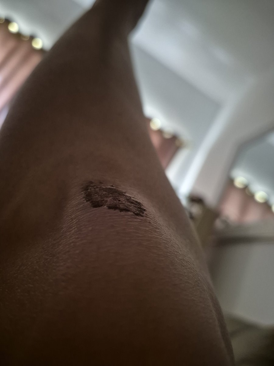 zaaaaang's tweet photo. Everytime I play basketball at elbi umuuwi akong may battle scars. Hahahuhu. https://t.co/O0MKKeeH0x