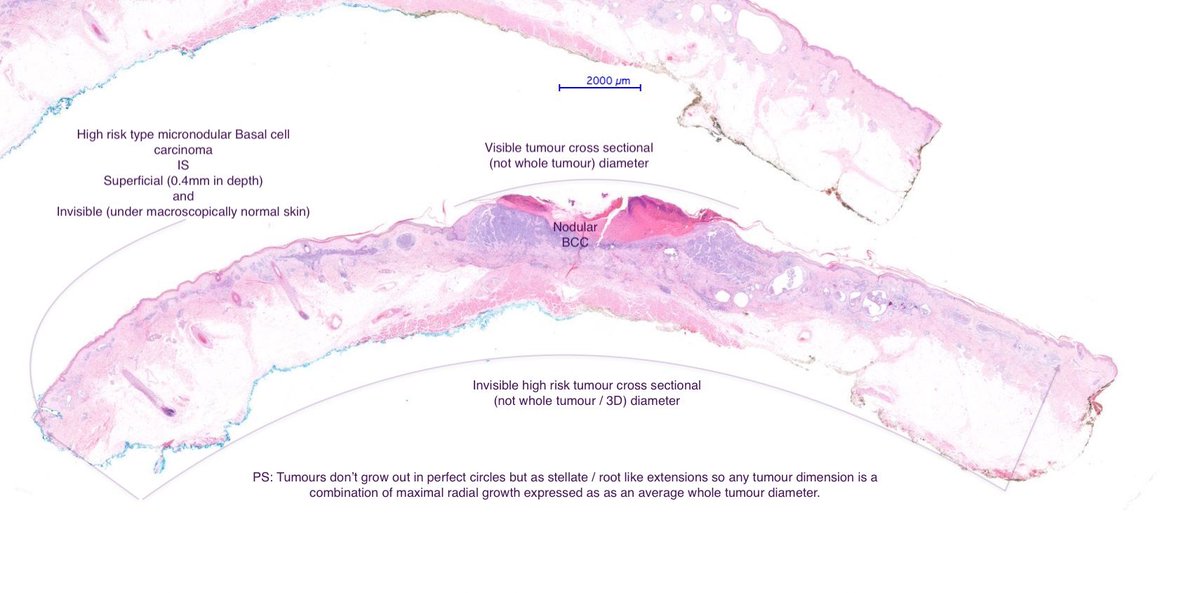 This is why Tumour staging based of depth and diameter will continue to have limitations in prognostic prediction.

#dermpath #dermx #pathx #skinpathology #dermatologia #dermatology  #dermatologist #skinpath #histopathology #dermatopathologia #dermatopathology #dermatopathologist