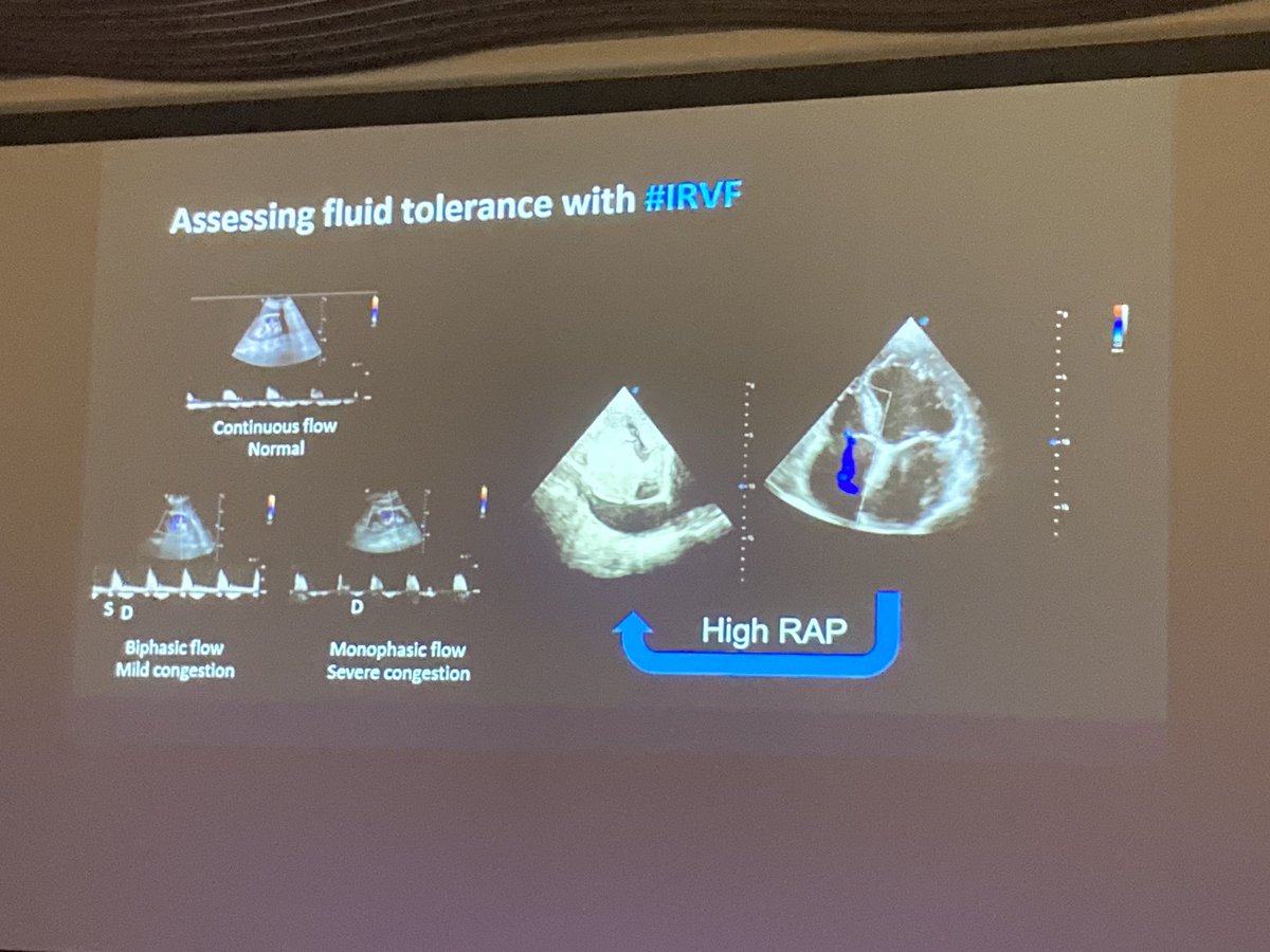 Súper interesante @Tubulocentric Hablando del POCUS para evaluar la congestión y el fallo renal en pacientes con cirrosis @AEcodigest #AEED2024 ..Cuando aumenta la presión en la aurícula derecha: Sistema Vexus (Más difícil de evaluar en pacientes con cirrosis hepática)