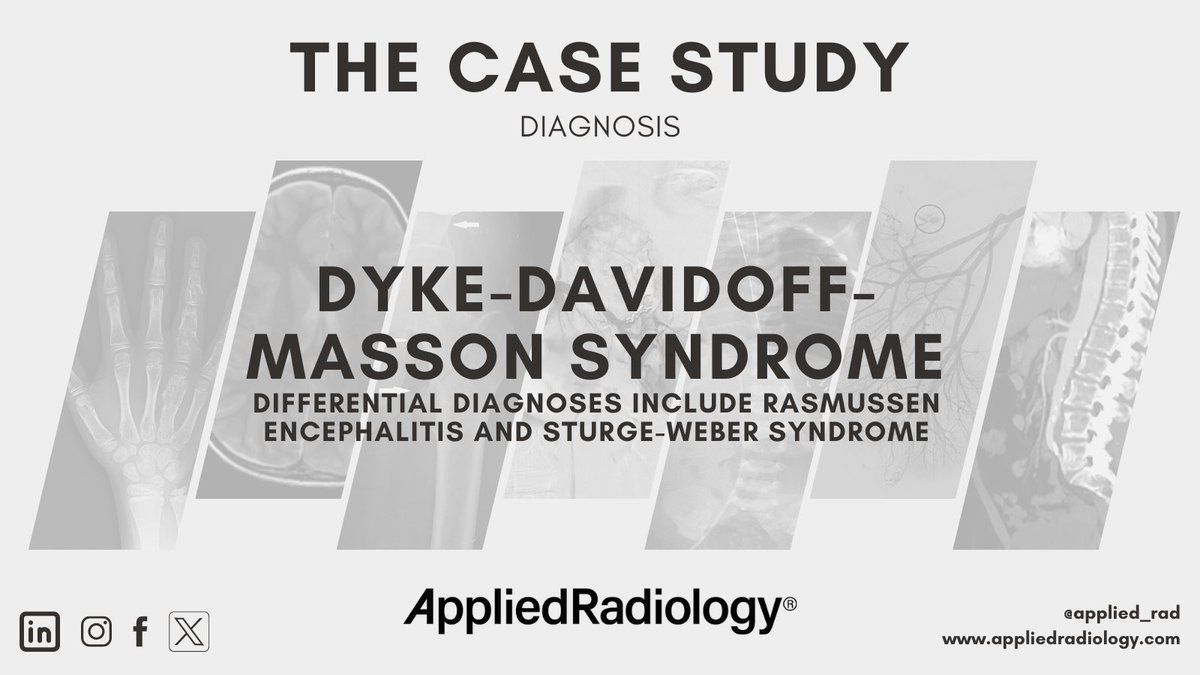🩻 Case Study of the Week! Dyke-Davidoff-Masson syndrome. Differential diagnoses include Rasmussen encephalitis and Sturge-Weber syndrome. See all the case details, more images, and diagnosis ➡️ bit.ly/3Wr5tE1 #RadEd #Radiology #RadRes #CaseStudy #PediatricRadiology