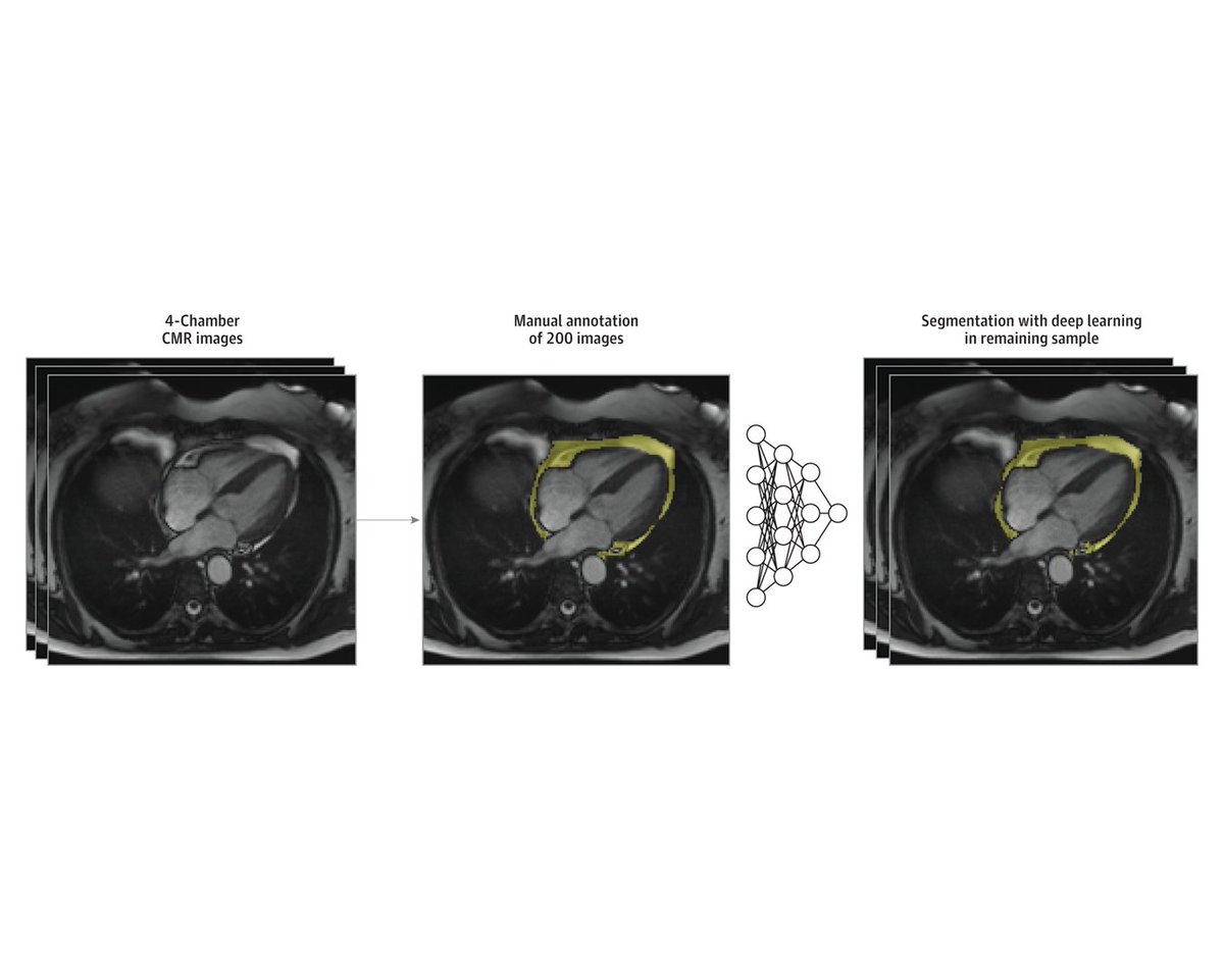 Many studies have suggested that fat tissue around the heart could act locally to influence cardiovascular disease risk. New findings from a study of 44,000 UK Biobank participants who underwent cardiac imaging challenge this theory. ja.ma/3WygeUV