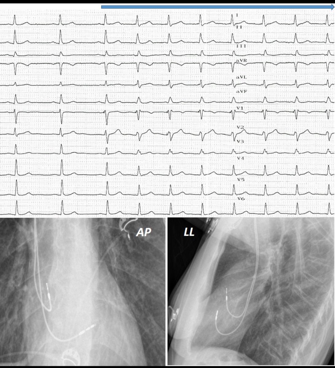 Taormina Antonio (@taorminaantoni1) on Twitter photo 70 yo-female with history of recurrent asystolic syncopes at ILR monitoring. LBB-P was performed. V6RWPT 60 ms, V6-V1 interpeak interval 44 ms. ECG after magnet apposition shows incomplete RBBB.
<a href="/ACLatini/">Alessia Chiara Latini</a> <a href="/filiberti_gaia/">Gaia Filiberti, MD</a> <a href="/DrFalasconi/">Giulio Falasconi, MD</a> <a href="/diegopenela1/">diego penela</a> 70 yo-female with history of recurrent asystolic syncopes at ILR monitoring. LBB-P was performed. V6RWPT 60 ms, V6-V1 interpeak interval 44 ms. ECG after magnet apposition shows incomplete RBBB.
<a href="/ACLatini/">Alessia Chiara Latini</a> <a href="/filiberti_gaia/">Gaia Filiberti, MD</a> <a href="/DrFalasconi/">Giulio Falasconi, MD</a> <a href="/diegopenela1/">diego penela</a>