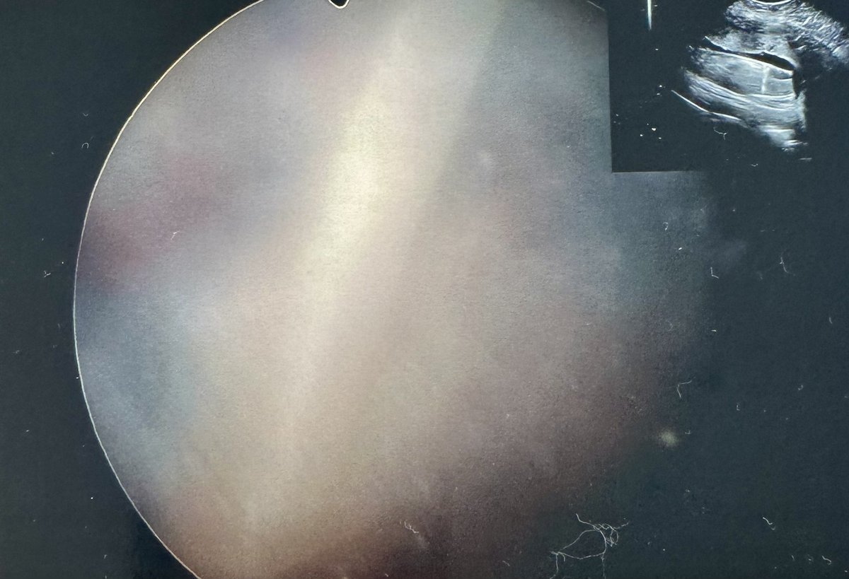 Type II Vasa Previa.

Fetoscopic images of a laser ablated vasa previa at 32 weeks’ gestation.

After successful ablation, the threat of fetal hemorrhage is removed. So no need for hospitalization, and patient is a candidate for term vaginal delivery.

#FetalSurgery #VasaPrevia