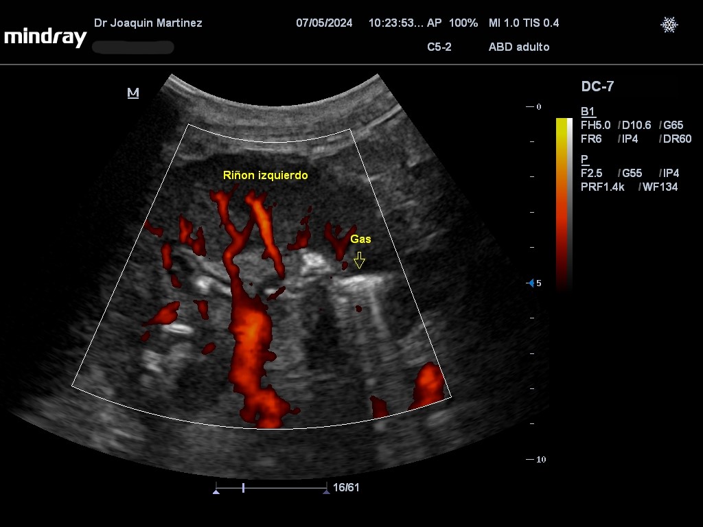 Femenino 51 años, DM tipo II con vejiga neurogénica y retinopatía diabética asociada. Uroanálisis con leucocitos incontables. Artefactos hiperecogénicos con reverberación posterior en sistema excretor izquierdo, móviles.