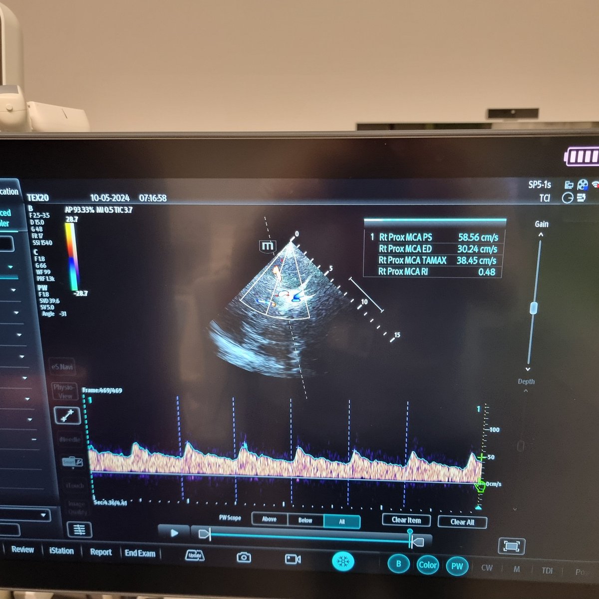 Adrian Wong (@avkwong) on Twitter photo The inaugural #neuro #pocus course at <a href="/KingsCritCare/">King's Critical Care</a>
Sorry <a href="/aartisarwal/">Aarti Sarwal, FNCS, FAAN, FCCM, RPNI, Professor</a> <a href="/chiara_robba/">Chiara Robba</a> <a href="/LauretaPereta/">Laura Galarza</a>, we've finally done it The inaugural #neuro #pocus course at <a href="/KingsCritCare/">King's Critical Care</a>
Sorry <a href="/aartisarwal/">Aarti Sarwal, FNCS, FAAN, FCCM, RPNI, Professor</a> <a href="/chiara_robba/">Chiara Robba</a> <a href="/LauretaPereta/">Laura Galarza</a>, we've finally done it
