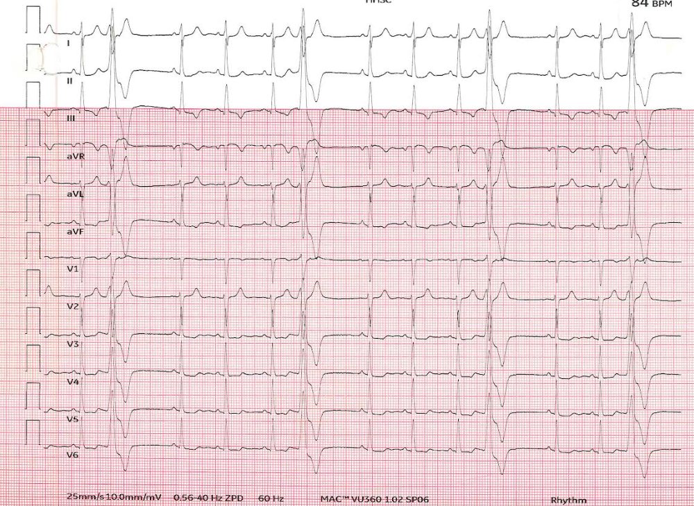 Likely SOO? Where do you thnk we can nain this PVC? #EPeeps