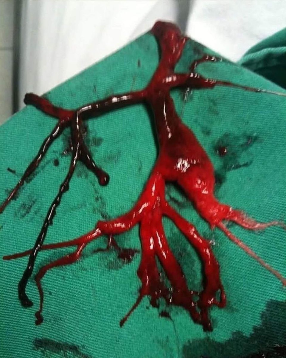 A huge blood clot removed with rigid bronchoscopy from the airways