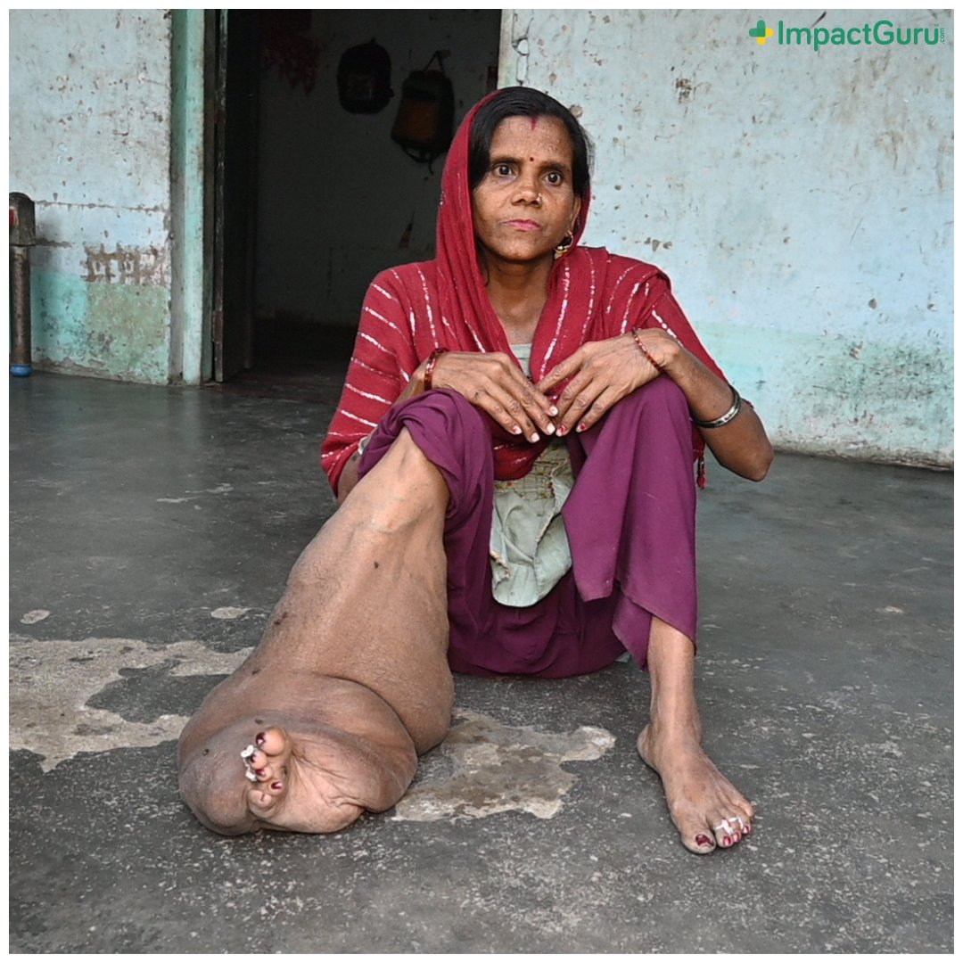 “I have had enough of a life of dependency & social ridicule. But how can anything #change my fate, till my leg stops puffing up? Only way out of this painful loop is a costly treatment. But my husband’s labor’s income cannot save my #life! Please help: bit.ly/4b8CucH