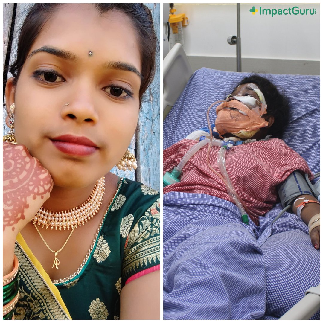 My daughter, Akshda, who is just 21 y/o, met with a terrible accident that left her with severe injuries to her hands, legs & face. Your contributions will make a world of difference in helping my daughter recover as soon as possible. Donate now: bit.ly/3UVbAis #Share