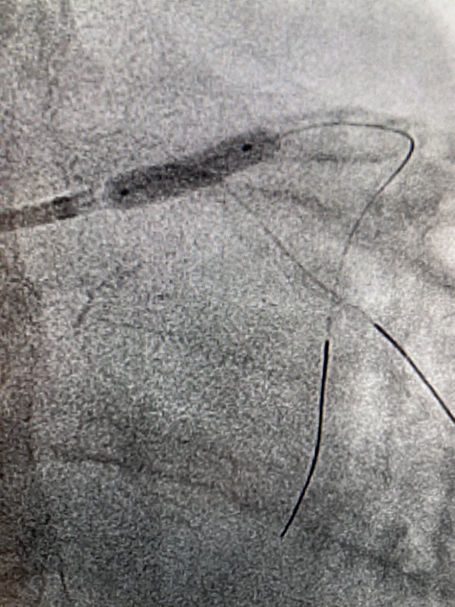 1/2 Another tool to treat Ca++ unprotected left main lesions. 95yo👨🏻‍🦳 w NSTEMI & nl EF. IVUS➡️ 180* arc of Ca++ in distal LM plaque. Rather than multiple inflations with #IVL or RA/OA did 1 inflation w #OPN 🎈at 35atm↘️ #CardioTwitter @sis_medical @SCAI @ACCinTouch