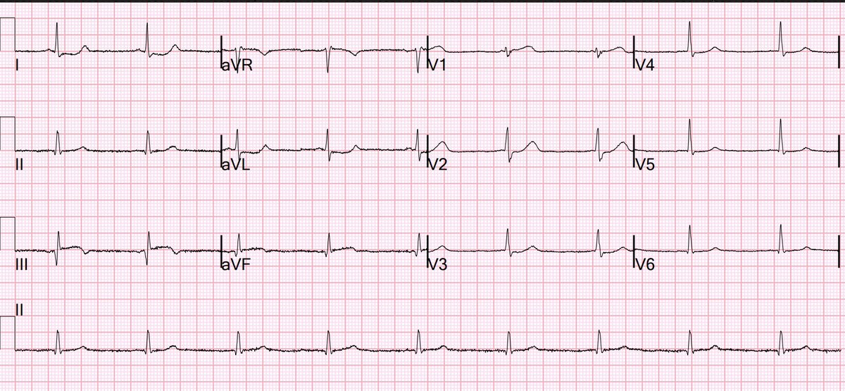 Why is this patient in shock? hqmeded-ecg.blogspot.com/2024/05/why-is…