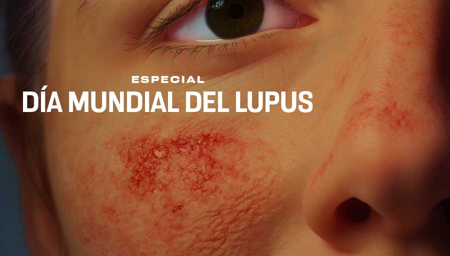 #UnDíaComoHoy se conmemora el Día Mundial del Lupus, con el objetivo de visibilizar esta enfermedad autoinmune crónica. Da clic al #Especial de @unamglobal > bit.ly/4dCRTU0