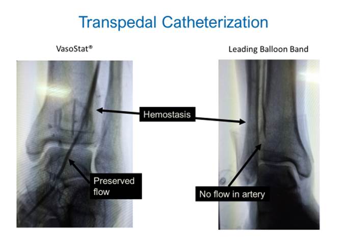 Note the preserved blood-flow when utilizing the #VasoStat in comparison to a balloon band device. #patenthemostasis #pedalfirst #vascularsurgeon #bloodflow