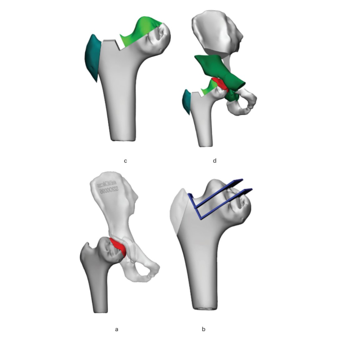 Ganz femoral head reduction associated with coverage and containment procedures improves radiological and functional outcomes in Perthes’ disease. #BJJ #Surgeons #Osteotomy ow.ly/JUQZ50RuImW