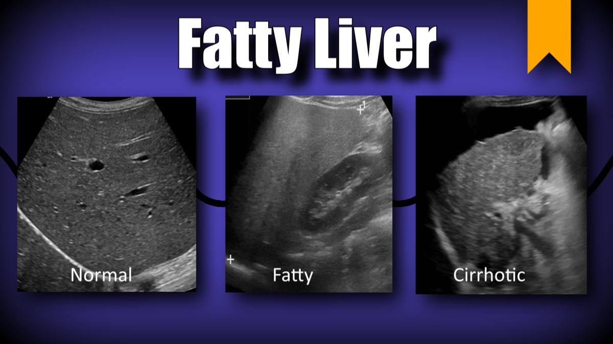 @thelowcarb_rd Really sad to see. The fries 🍟 and soda 🥤 at fast food destroying our kids health every day. 

I see it as fatty liver when I diagnose on imaging. Seen kids as young as 7 yo with fatty liver. #MASLD #NAFLD