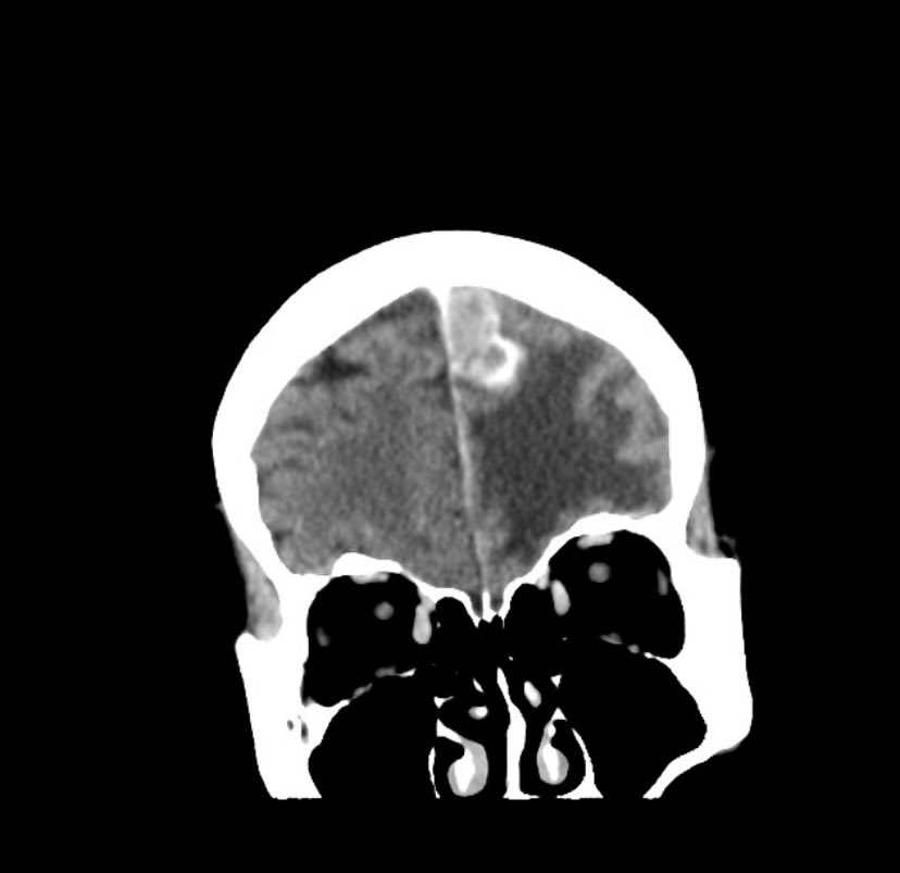 #Question
For medical students/ Junior doctors

65 year old lady
Known to have HR-/ HER2 + breast cancer with lung and liver metastases. She is on chemotherapy and dual anti-HER2 agents.

Presented to ER with severe headache, nausea and vomiting, and altered level of