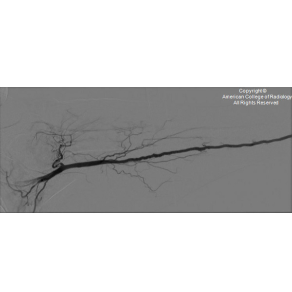 A 66-year-old woman presents for a bilateral upper-extremity angiogram. #ACRCaseinPoint bit.ly/3xW1CVd