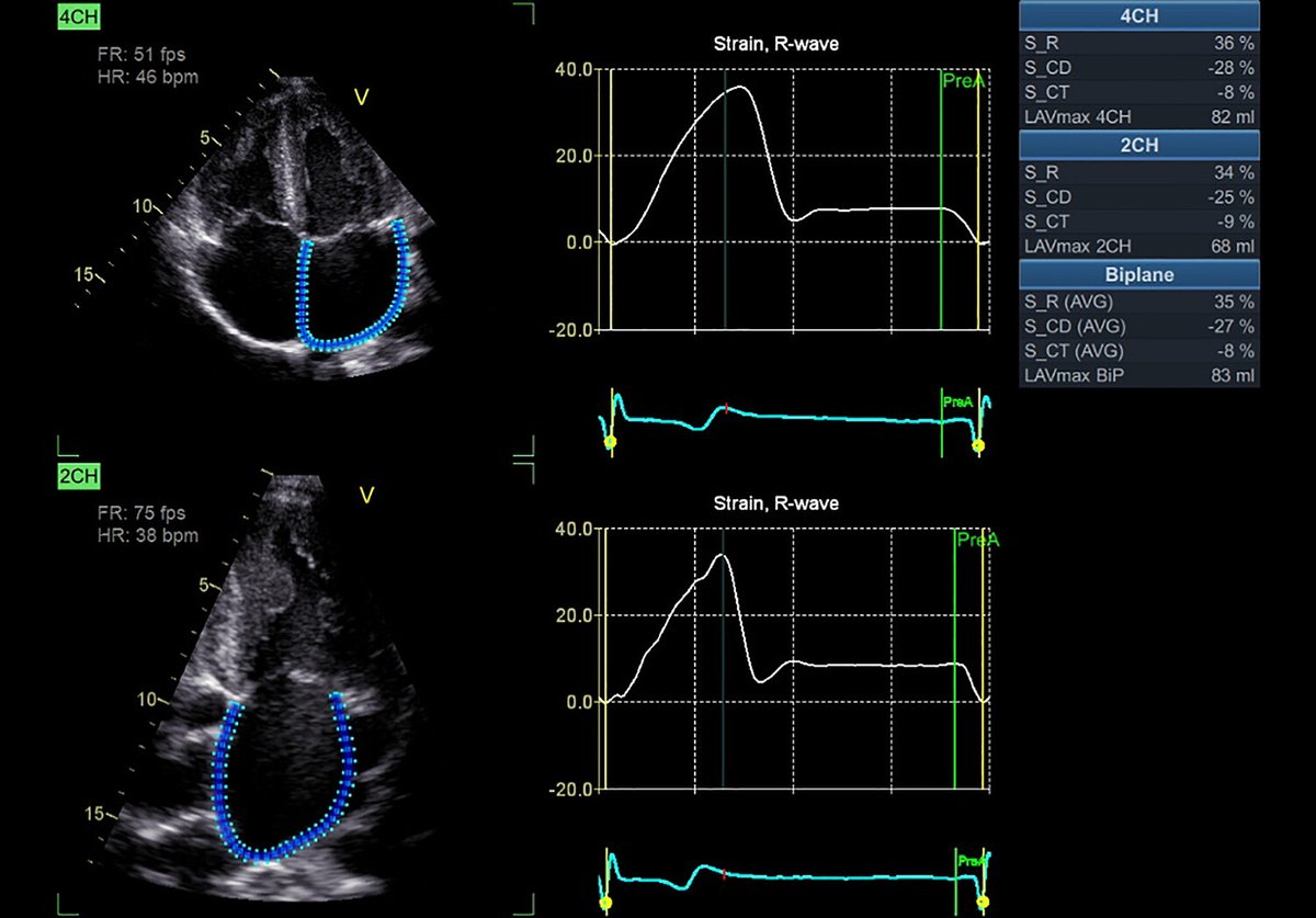 AJP-Heart and Circ (@ajpheartcirc) on Twitter photo New findings from <a href="/UniMelbMDHS/">UniMelb MDHS</a> published in Call for Papers on #Exercise, #PhysicalActivity, and #Cardiovascular Health characterizes the influence of #cardiorespiratory #fitness on #LeftAtrial size and function in the general population ow.ly/AhpK50RBw1G New findings from <a href="/UniMelbMDHS/">UniMelb MDHS</a> published in Call for Papers on #Exercise, #PhysicalActivity, and #Cardiovascular Health characterizes the influence of #cardiorespiratory #fitness on #LeftAtrial size and function in the general population ow.ly/AhpK50RBw1G